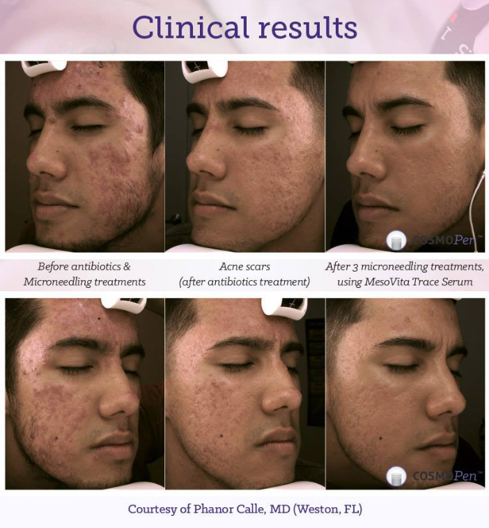 Dr Calle Acne Treatment Young Man before after.png