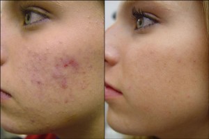 acne treatments 300x200