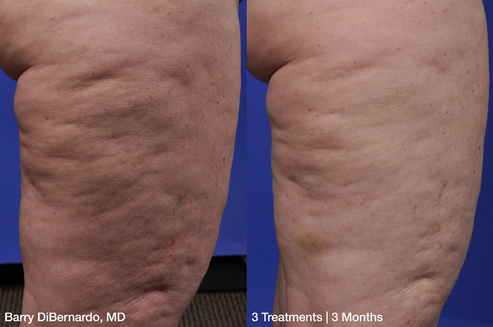 Cellulite thigh improvement before and after photo.png