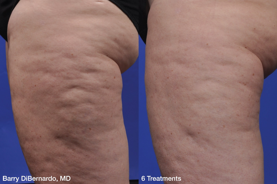 Cellulite thigh before and after 6 treatments photo.png