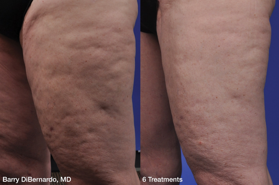 Cellulite thigh before and after 6 treatments photo.png