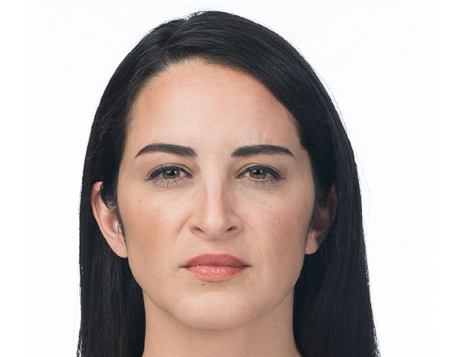 Botox cosmetic weston after frown lines woman face.png