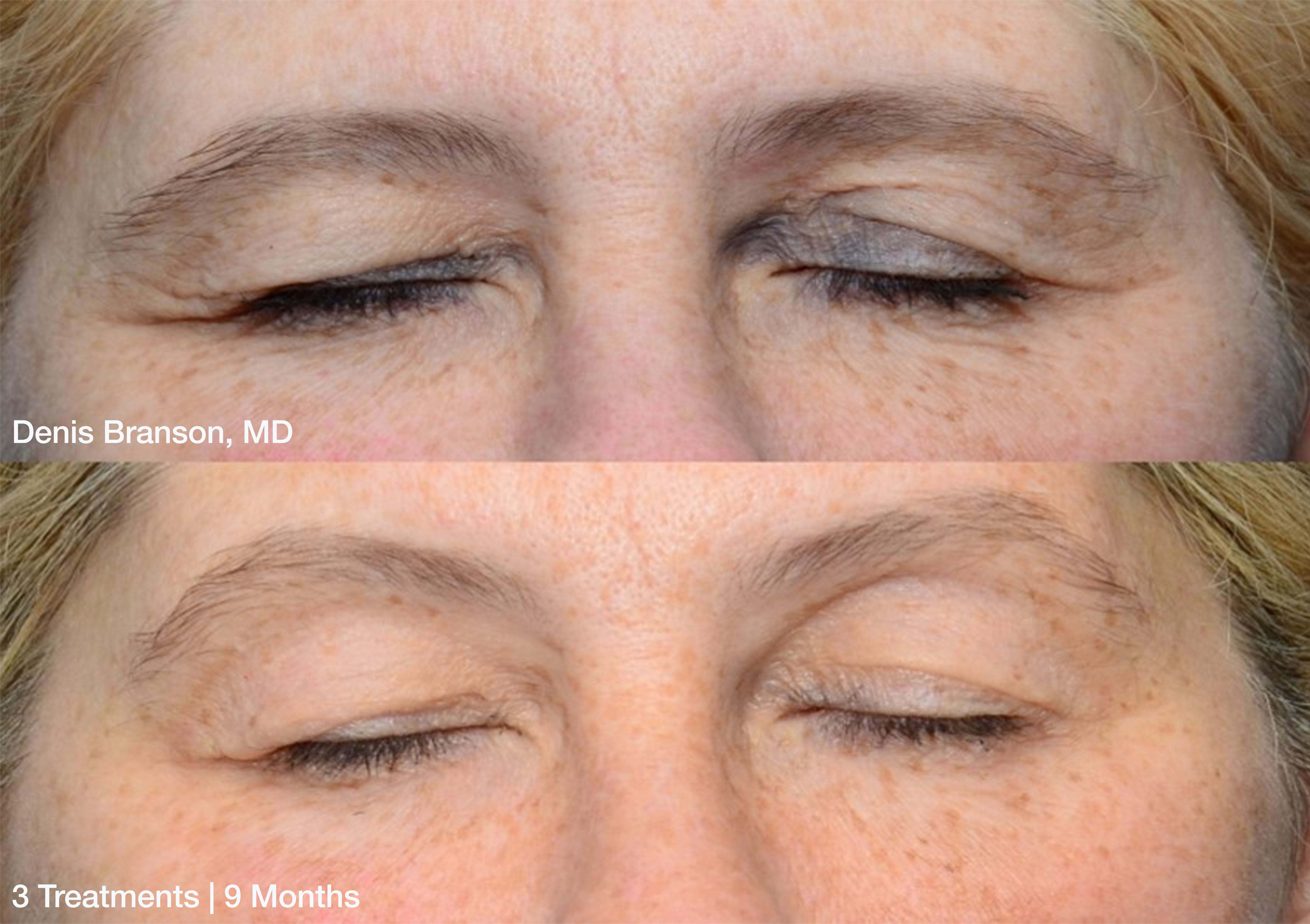 ThermiSmooth Facial Skin Tightening Eyes 3 treatments.png