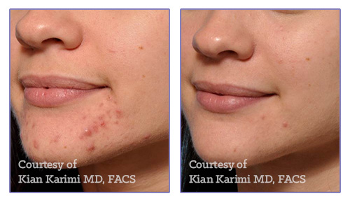 micronedling for acne woman face before and after.png